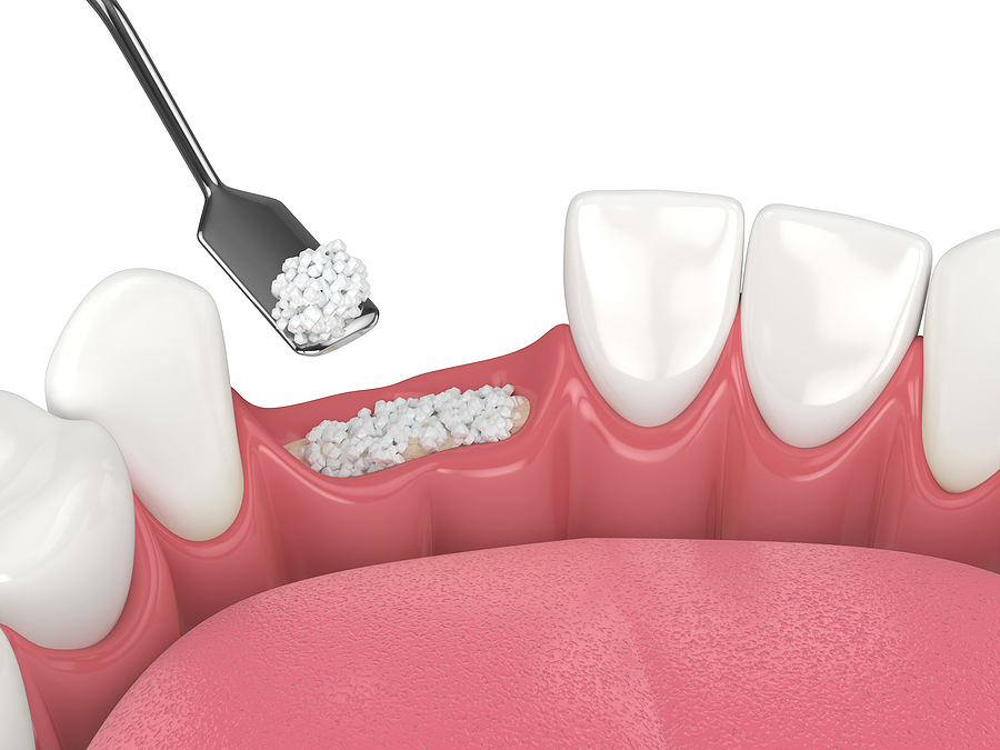 The Essential Guide to Bone Grafting in Bellevue, WA: Restoring Your Oral Health