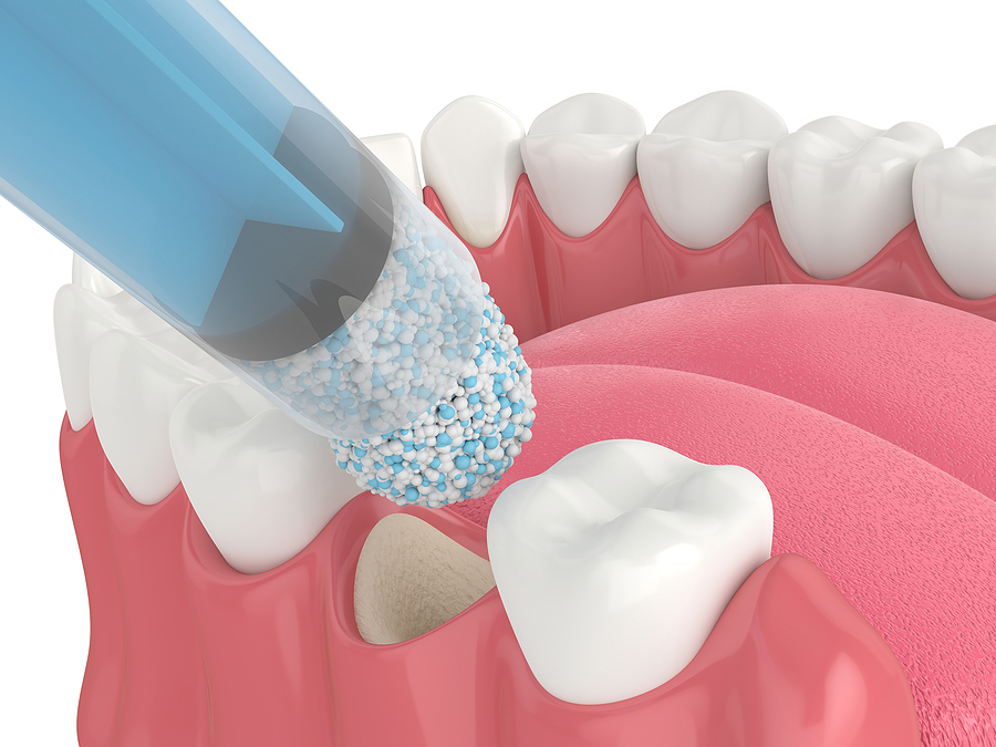 Bone Grafting: Restoring Jawbone Health for a Stronger Smile
