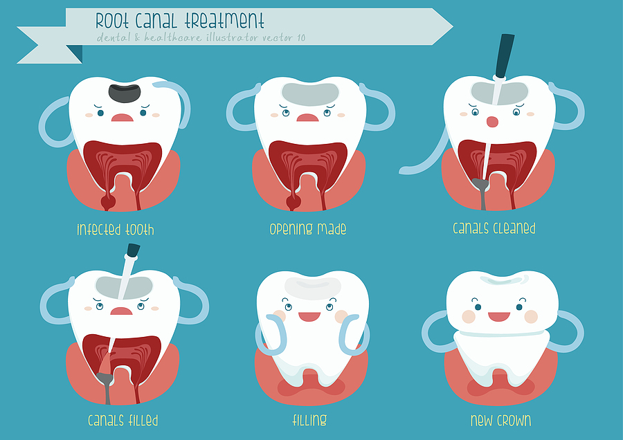Everything You Need to Know About Root Canals: A Comprehensive Guide
