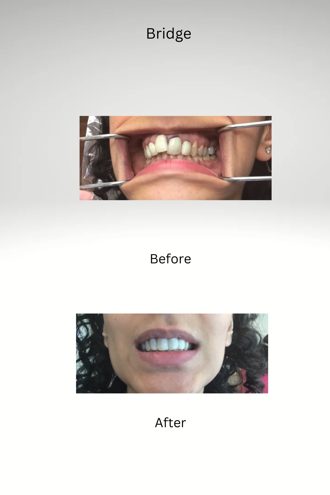 Bridge Case Before and After