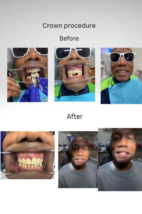 Crown Procedure
