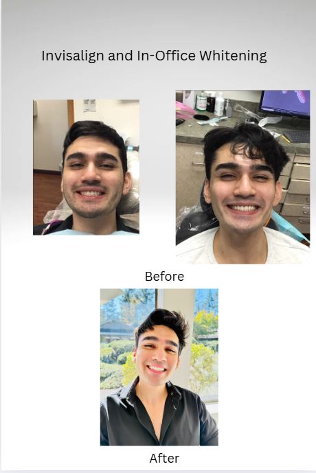 Invisalign and Whitening