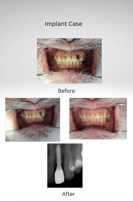 Implant Before and After