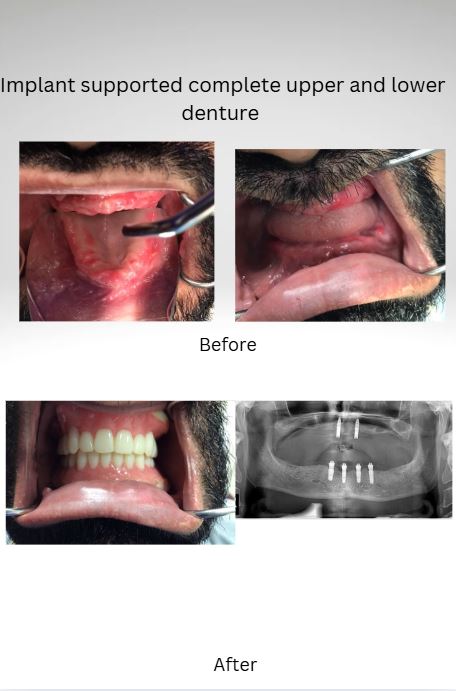 Implant Supported Complete Upper and Lower Denture