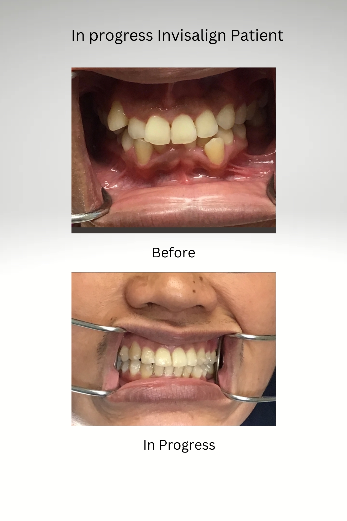 In Progress Invisalign Patient