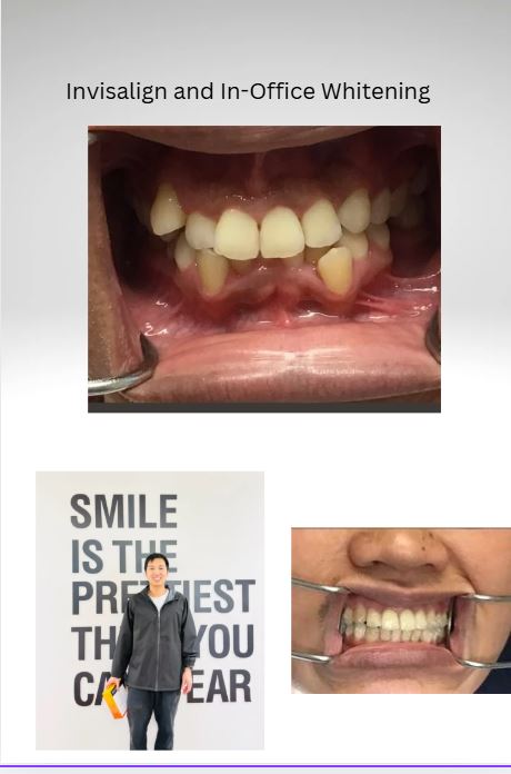 Invisalign Case Before and After 3