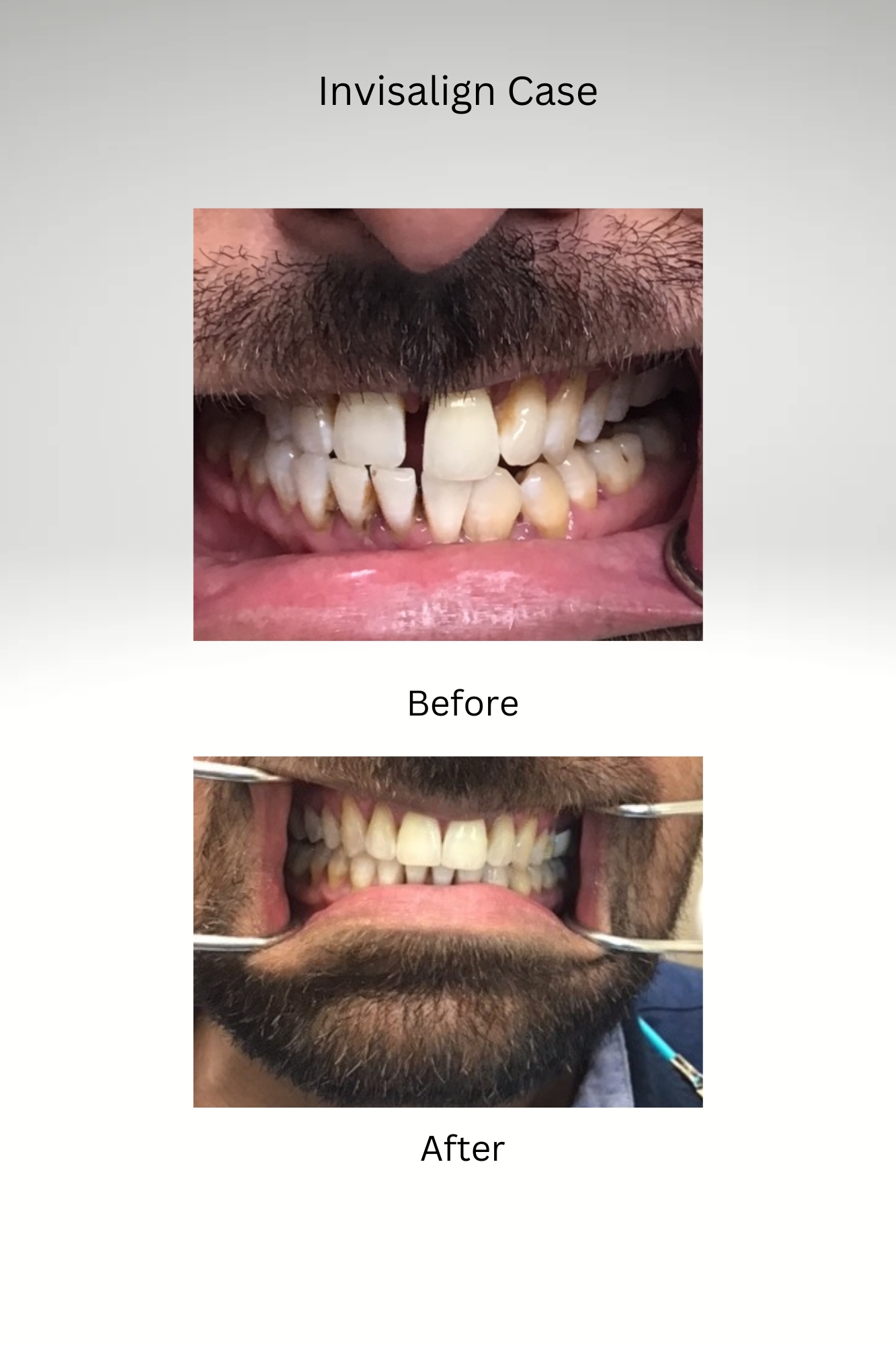 Invisalign Case Before and After 2