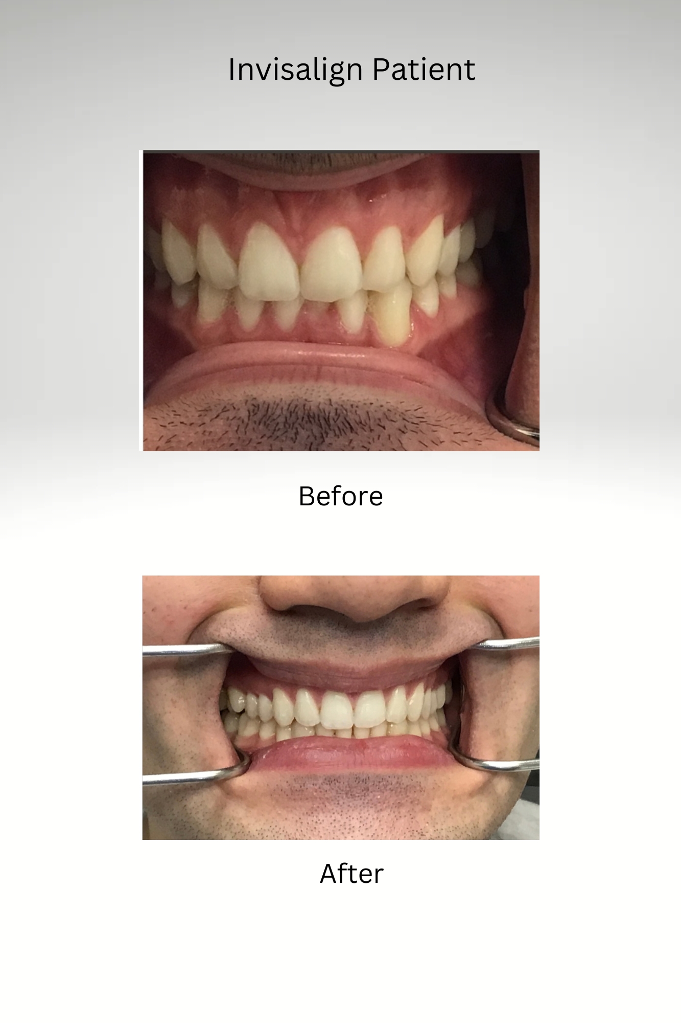 Invisalign Patient Before and After