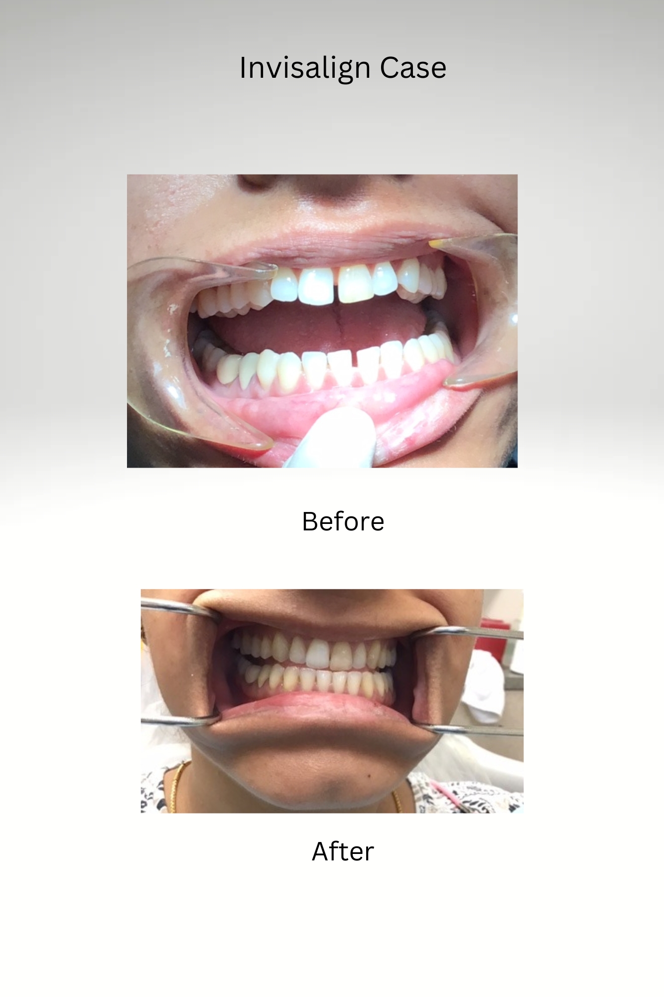 Invisalign Case Before and After