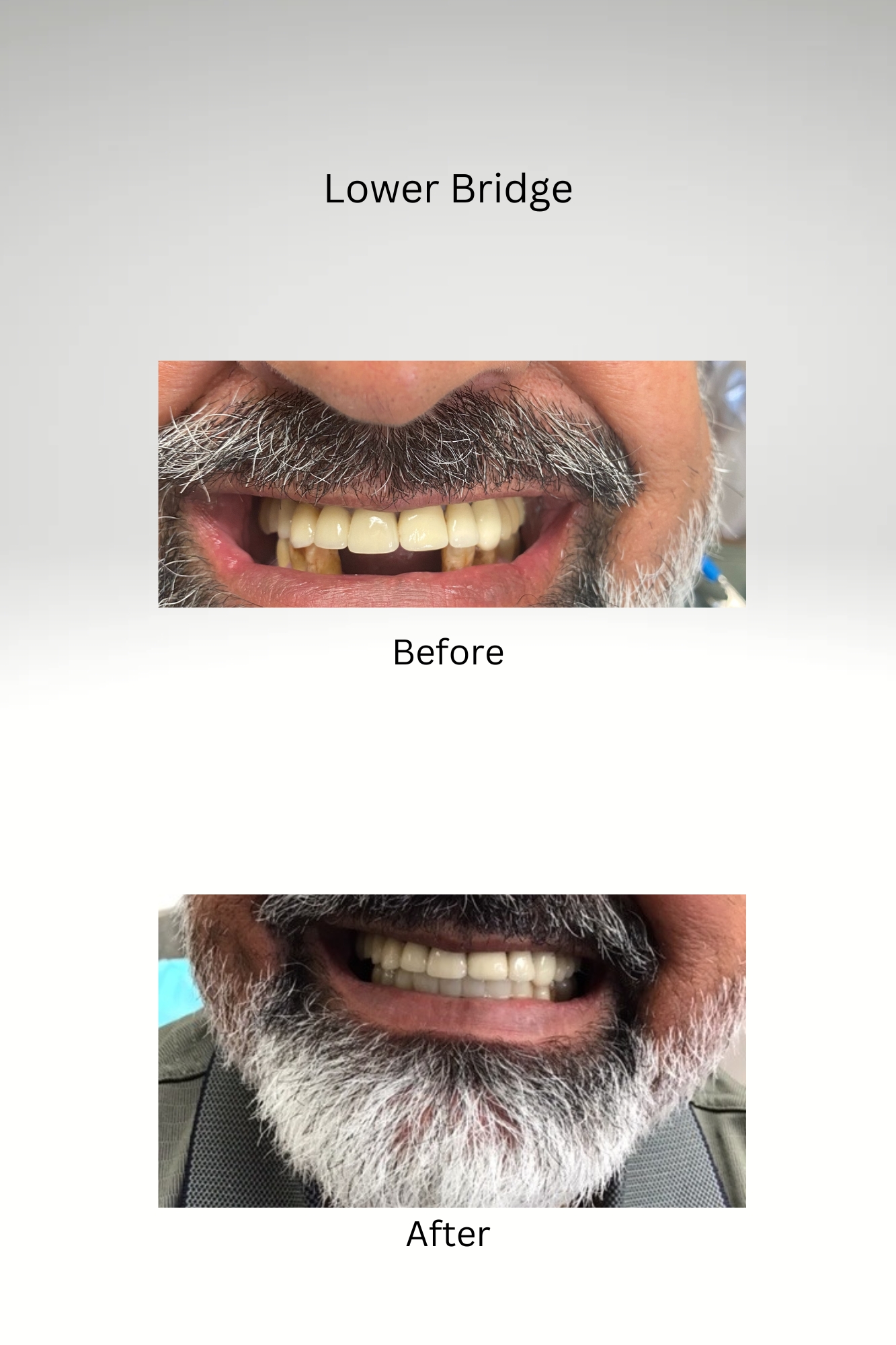 Lower Bridge Before and After