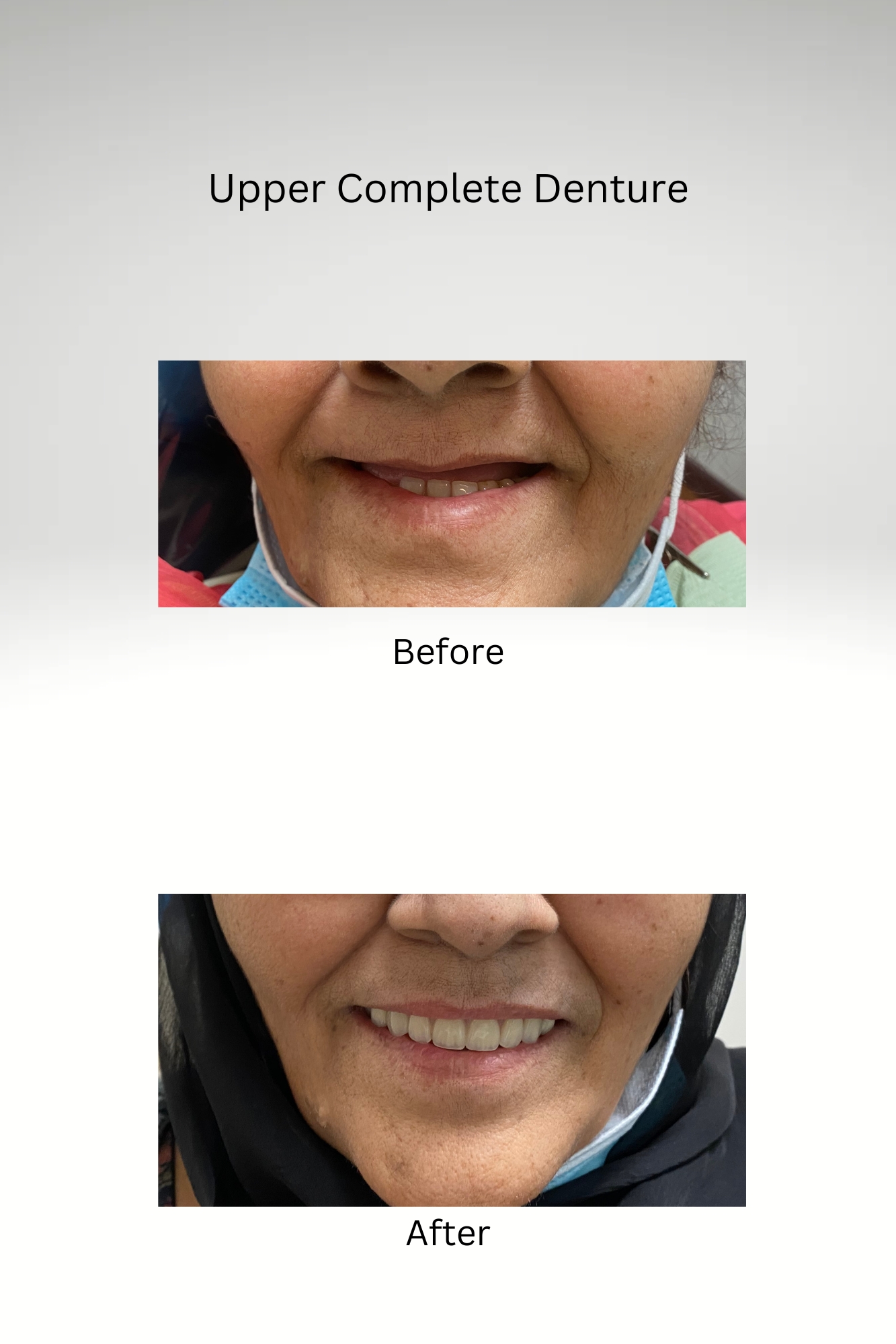 Upper Complete Denture Before and After