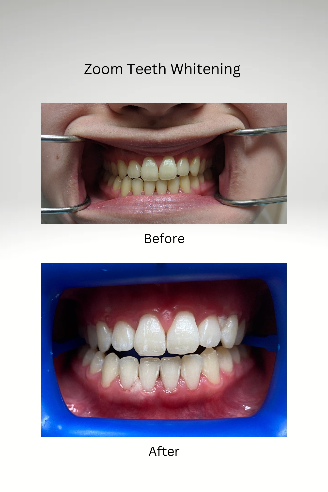 Whitening Before and After