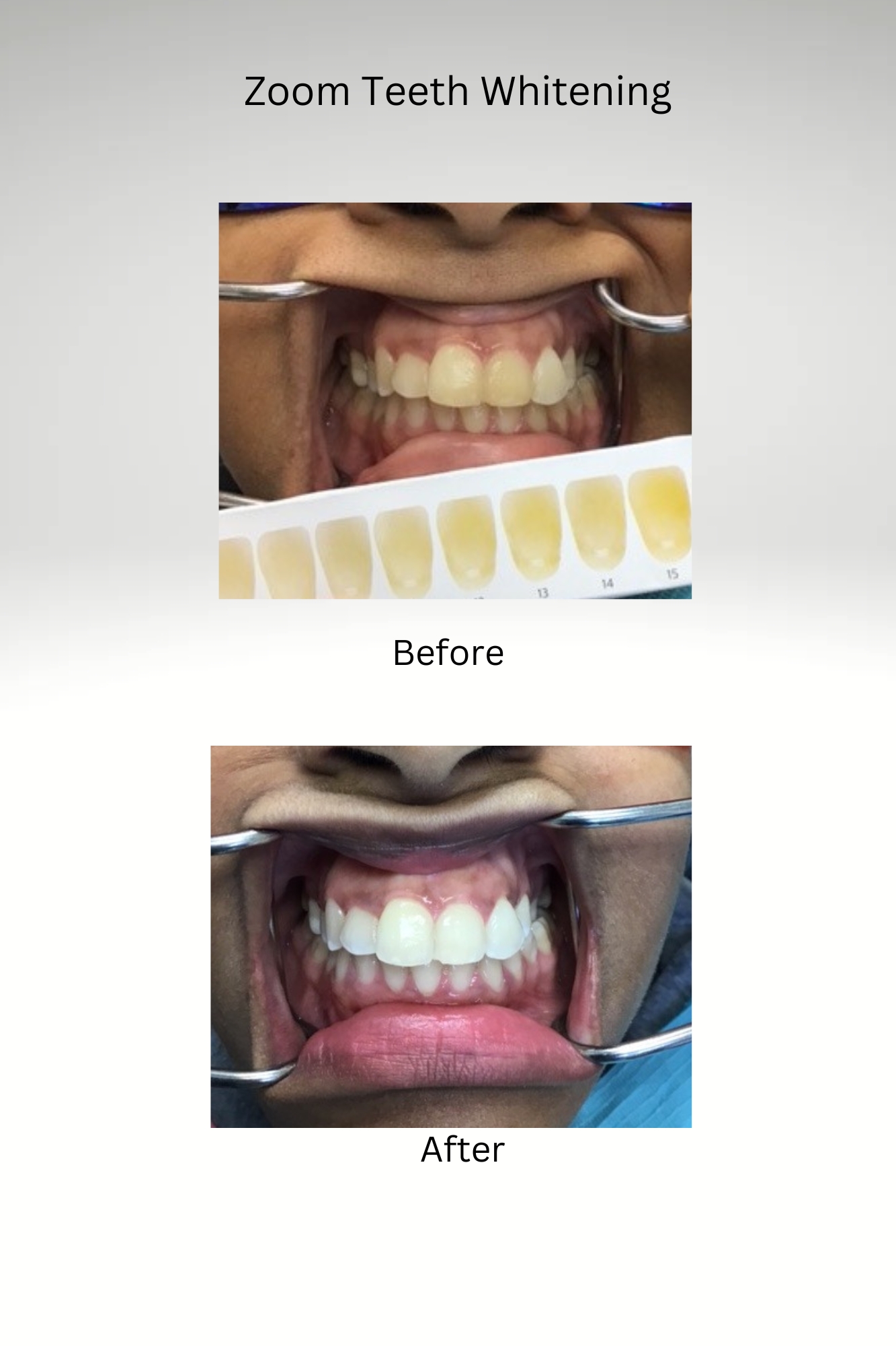 Zoom Teeth Whitening Before and After